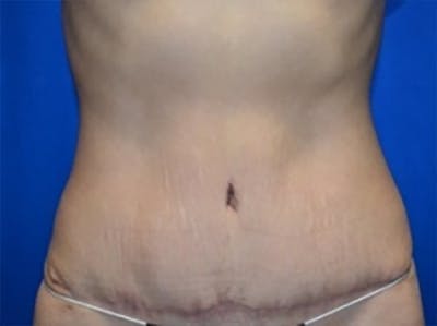 Tummy Tuck Before & After Gallery - Patient 227453 - Image 2
