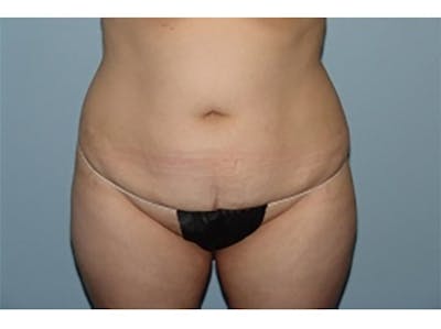 Tummy Tuck Before & After Gallery - Patient 547633 - Image 1