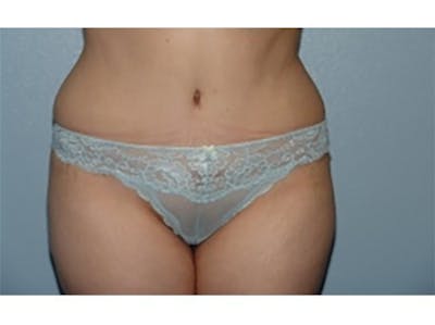 Tummy Tuck Before & After Gallery - Patient 547633 - Image 2