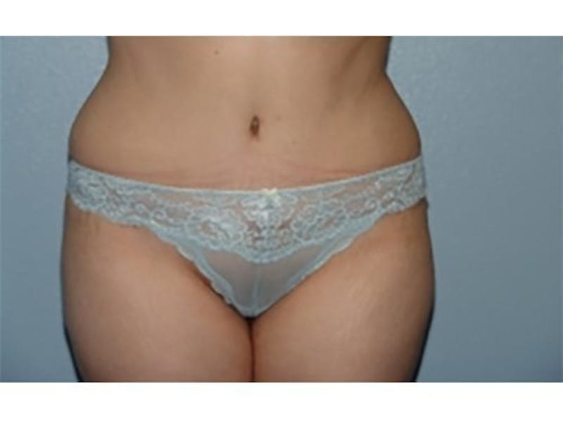 Tummy Tuck Before & After Gallery - Patient 547633 - Image 2