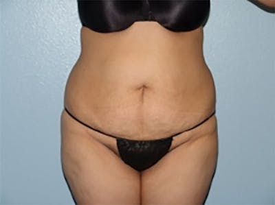 Tummy Tuck Before & After Gallery - Patient 305778 - Image 1