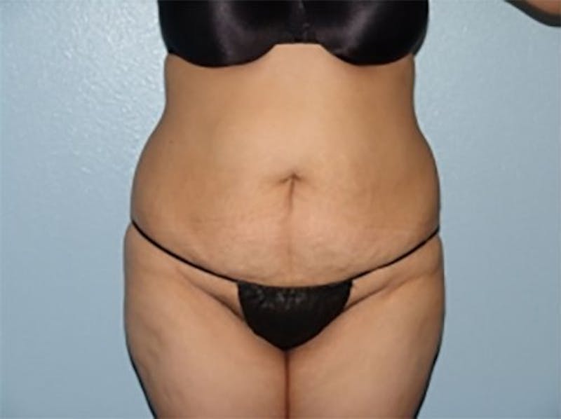 Tummy Tuck Before & After Gallery - Patient 305778 - Image 1