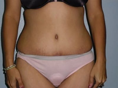 Tummy Tuck Before & After Gallery - Patient 305778 - Image 2