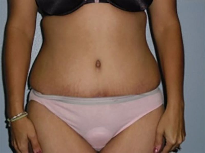 Tummy Tuck Before & After Gallery - Patient 305778 - Image 2