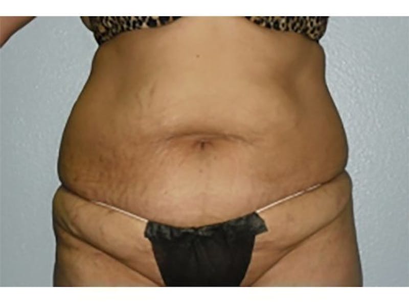 Tummy Tuck Before & After Gallery - Patient 170162 - Image 1