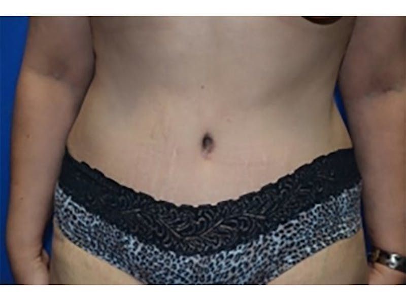 Tummy Tuck Before & After Gallery - Patient 170162 - Image 2