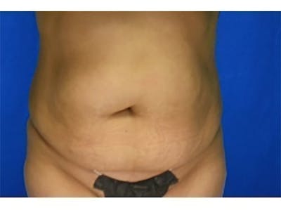 Tummy Tuck Before & After Gallery - Patient 104175 - Image 1