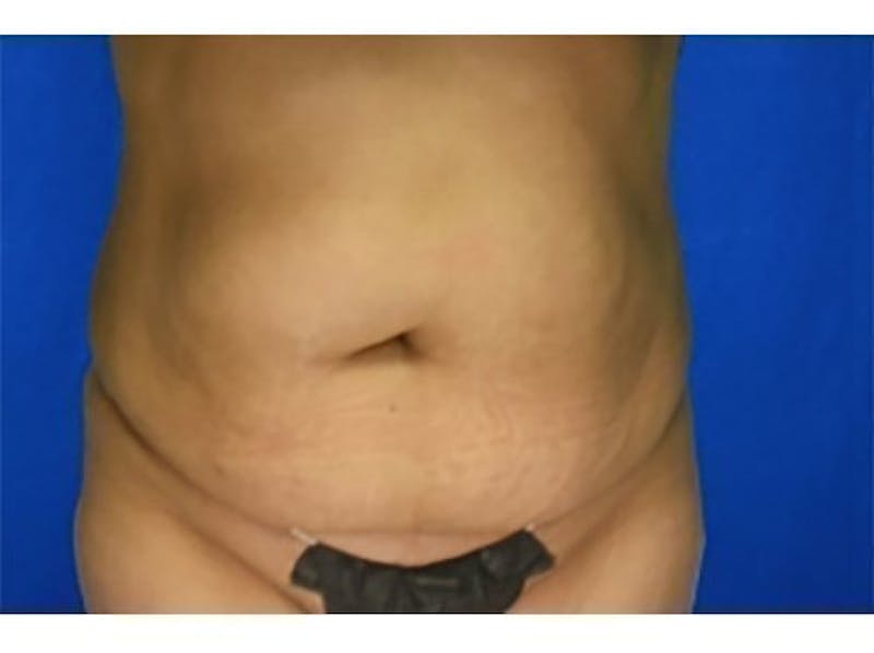 Tummy Tuck Before & After Gallery - Patient 104175 - Image 1