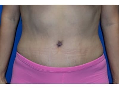 Tummy Tuck Before & After Gallery - Patient 104175 - Image 2