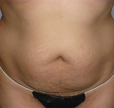Tummy Tuck Before & After Gallery - Patient 402844 - Image 1
