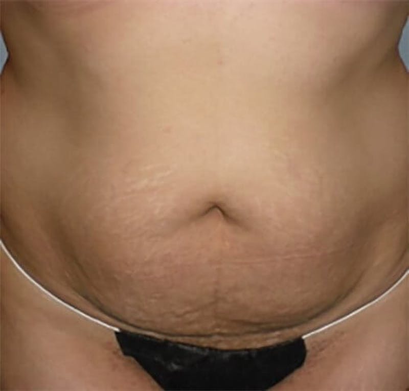 Tummy Tuck Before & After Gallery - Patient 402844 - Image 1