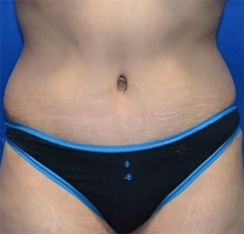 Tummy Tuck Before & After Gallery - Patient 402844 - Image 2