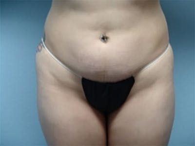 Tummy Tuck Before & After Gallery - Patient 410068 - Image 1
