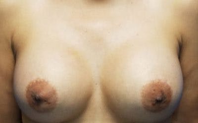 Breast Augmentation Before & After Gallery - Patient 323397 - Image 2