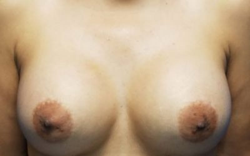 Breast Augmentation Before & After Gallery - Patient 323397 - Image 2