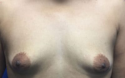 Breast Augmentation Before & After Gallery - Patient 323397 - Image 1