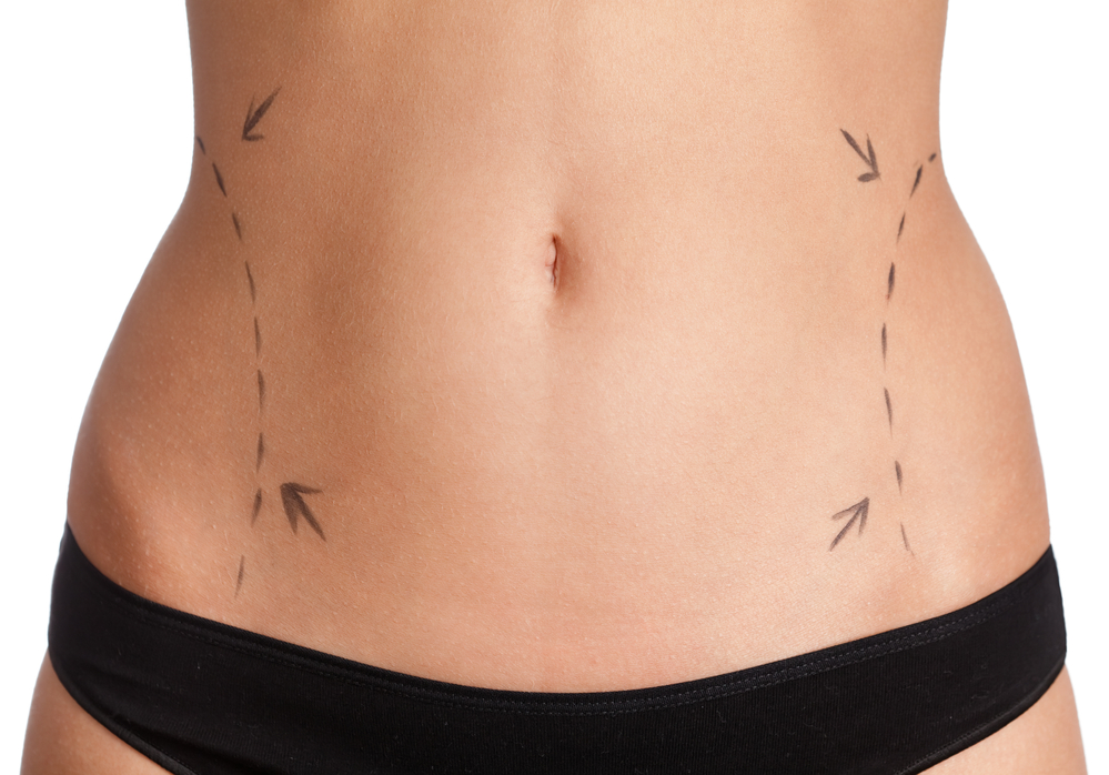Vaser Liposuction | Rios Center for Plastic Surgery | Vaser Lipo