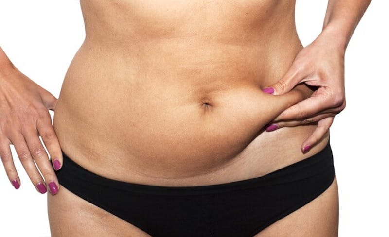 Do I Need a Tummy Tucks or Liposuction? 6 Main Differences