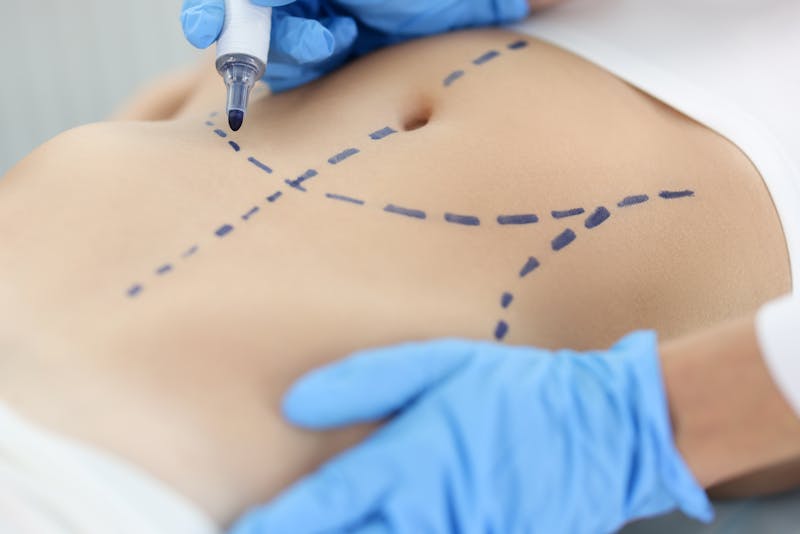 Surgeon making marks on a woman's stomach for a tummy tuck.