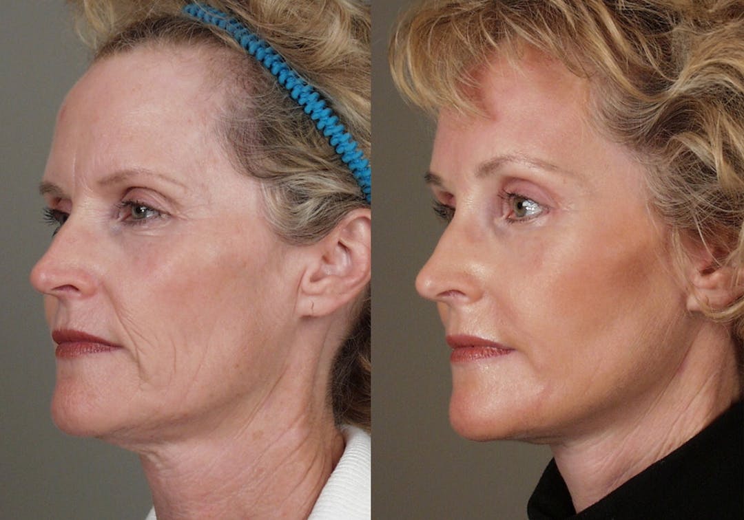 picture of woman's profile