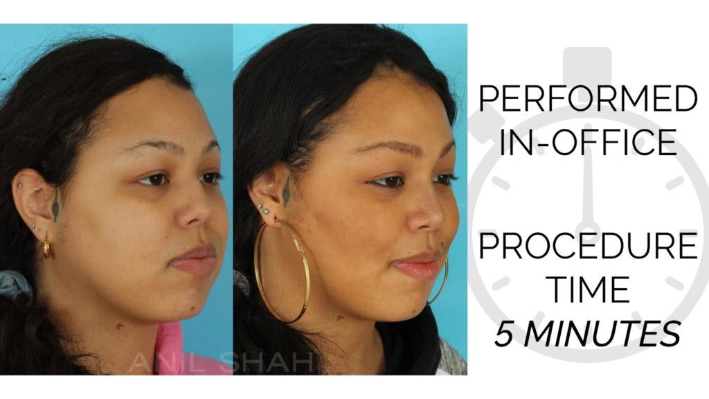 Buccal Fat Removal vs. Kybella Anil Shah MD FACS