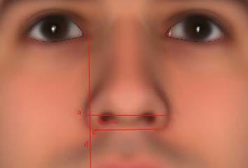 Alar Base Width (Determining Width of the Base or Bottom of the Nose)