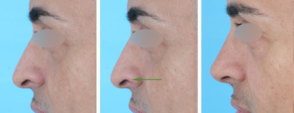 Alar Rim Grafts Nasal - Before & After