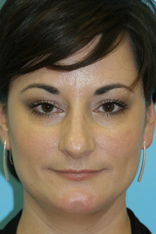 Rhinoplastia front Before picture Chicago