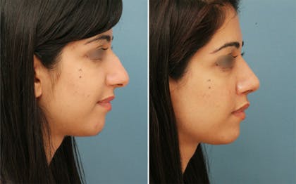 Before and after photos of patient of Dr. Shah's