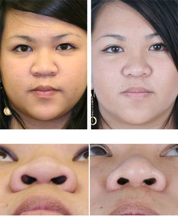 Before and after photos of patient of Dr. Shah's