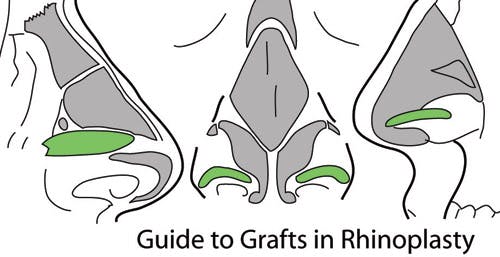 Guide to Grafts in Rhinoplasty