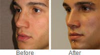 Male Rhinoplasty before after
