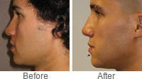 Male Rhinoplasty before after in Chicago