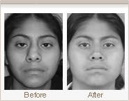 Crooked Nose Deformity before after