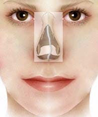 Crooked nose deformity 2