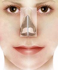 Crooked nose deformity 3