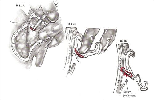 Otoplasty - Figure 3