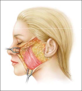 Artist's depiction of the platysma muscle with a significant extent into the midface