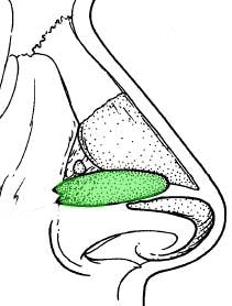 Open Rhinoplasty - Figure 9