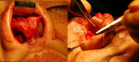 Nasal Reconstruction - Figure 3A & 3B