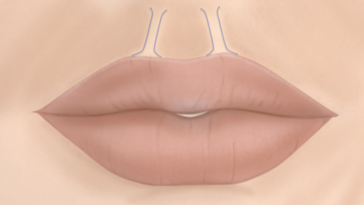 Lip Augmentation Chicago, IL Lip Injections Dr. Anil Shah
