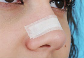 Taping After a Rhinoplasty