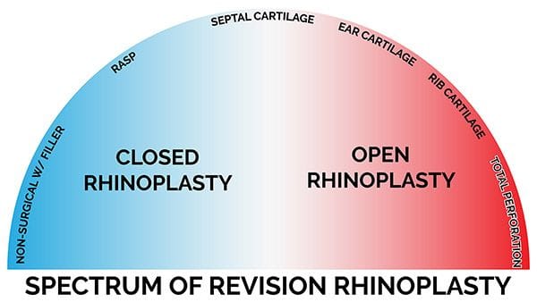 rhinoplasty infographic