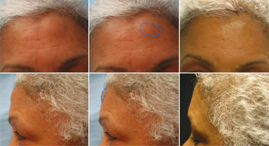 osteoma removal patient results