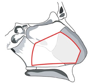 septoplasty illustration
