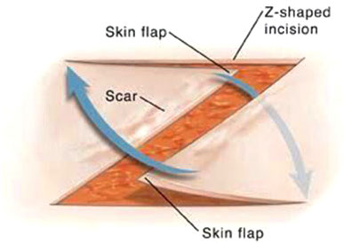 illustration of a scar