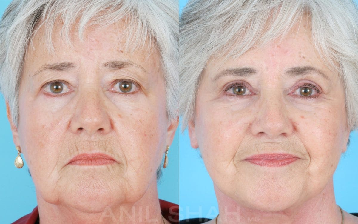 blepharoplasty patient results