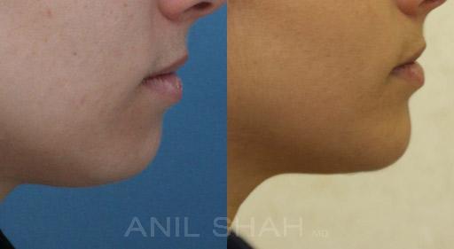 chin augmentation results