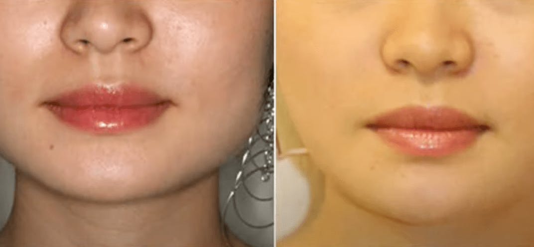 Masseter Reduction patient results