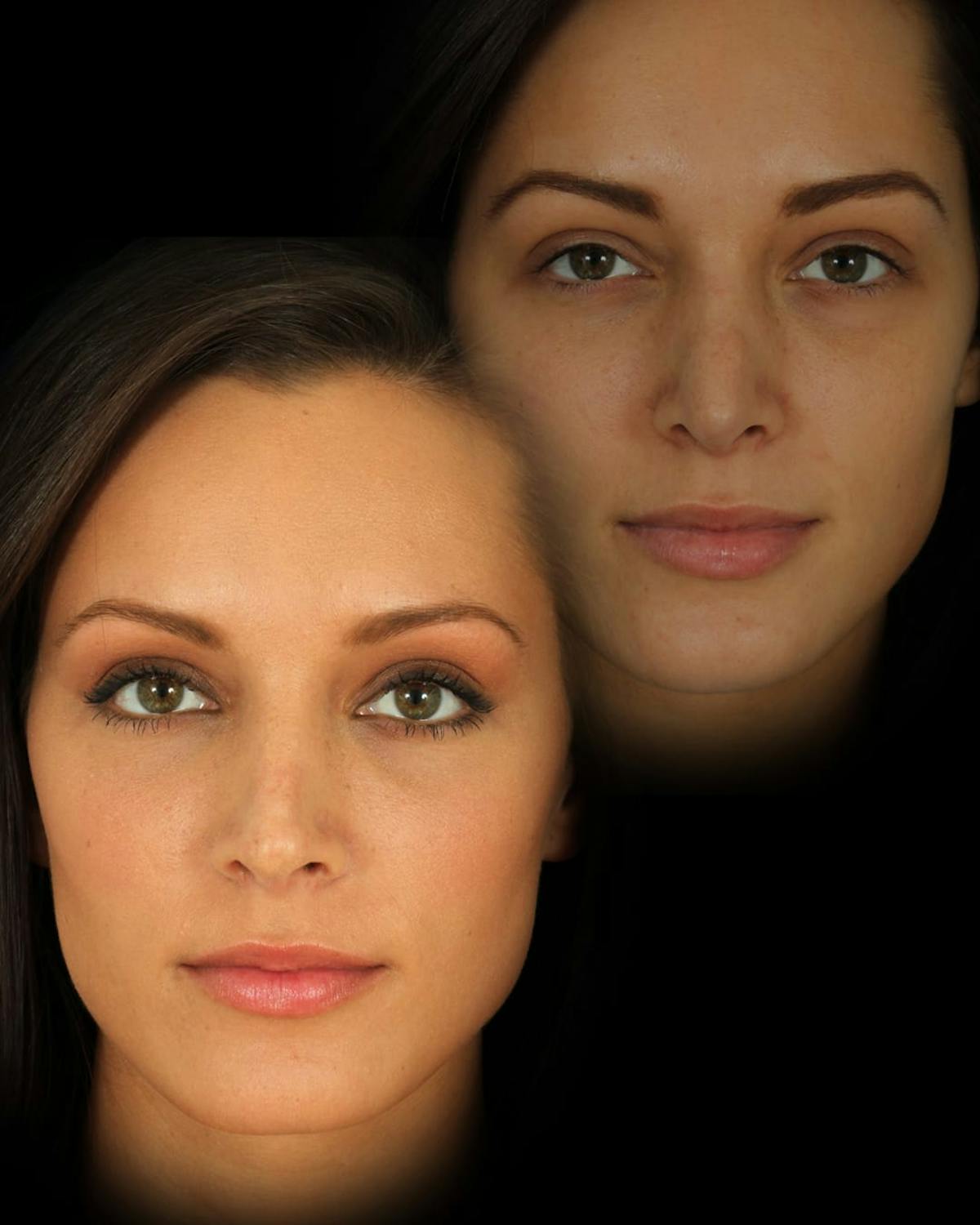 Rhinoplasty Before & After Gallery - Patient 371818 - Image 2